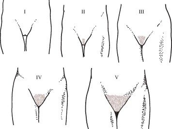 GYN_tanner_stages_pubic_hair