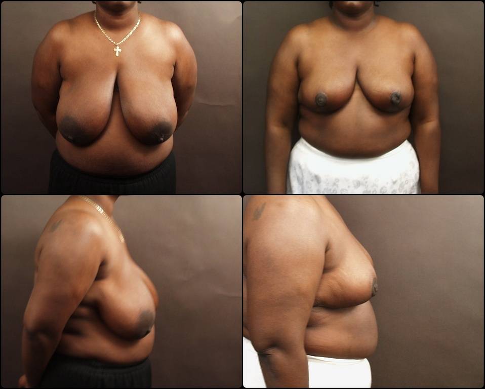 Breast-Reduction-before-160582