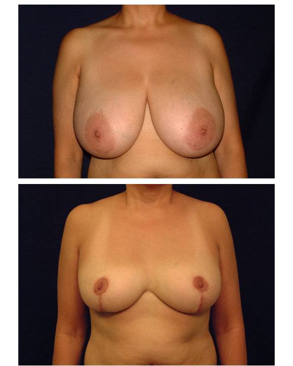 Breast-Reduction-before-286986