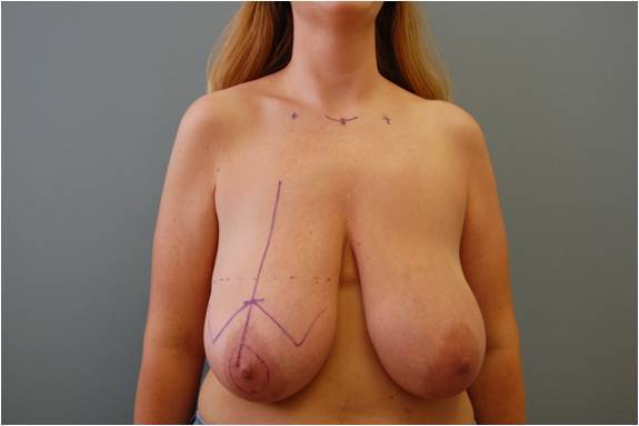 Breast-reduction-before-339326