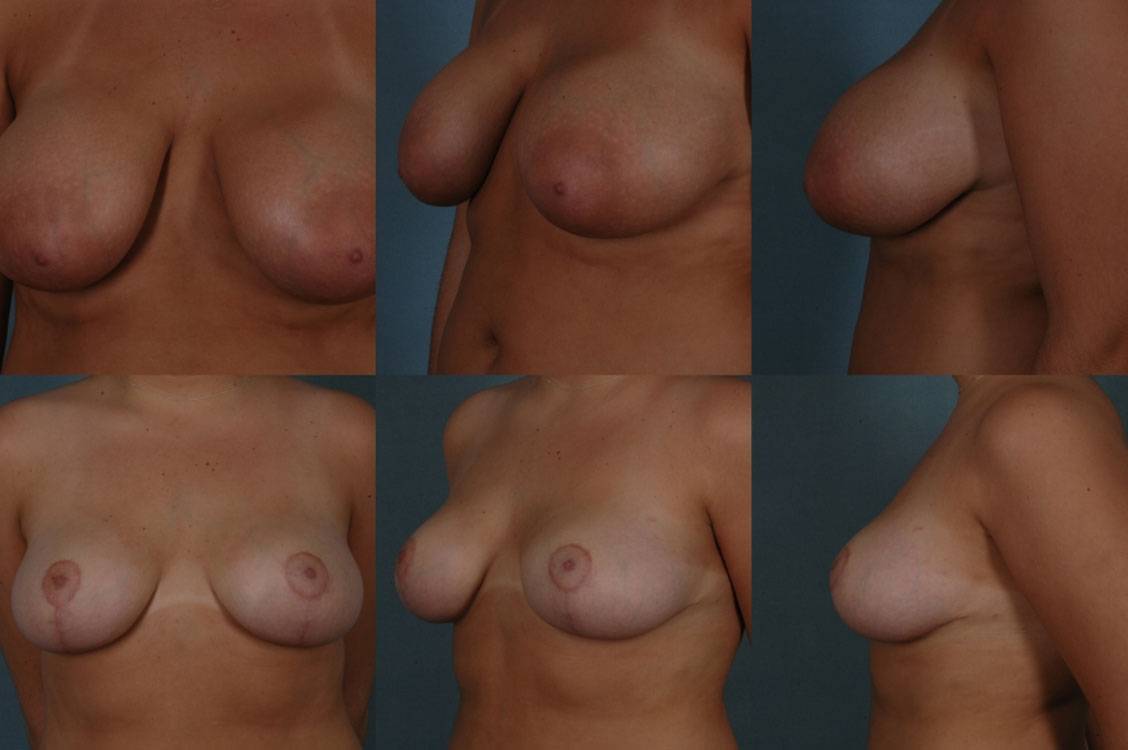 Breast-Reduction-23