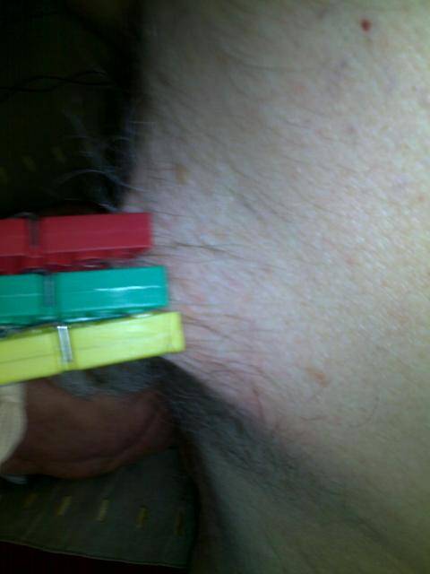 pegs on nipple 1