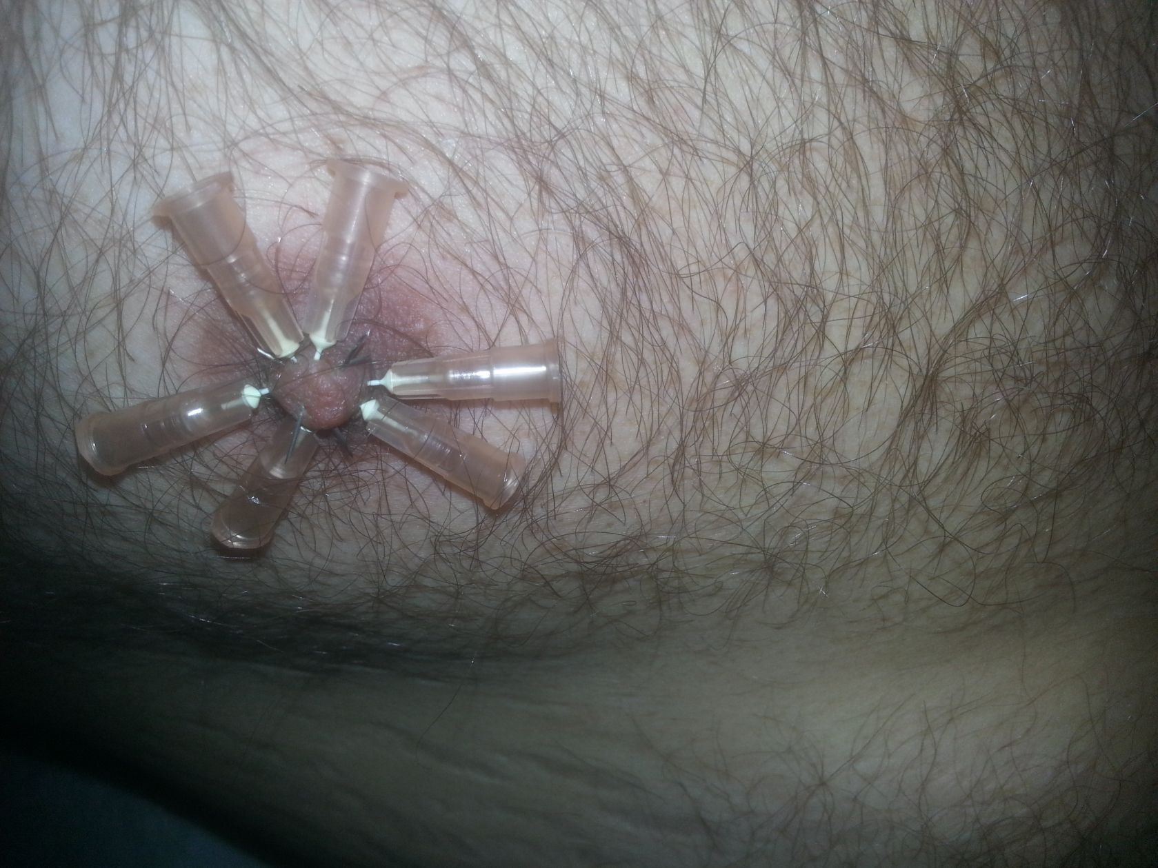 Needels - nipple