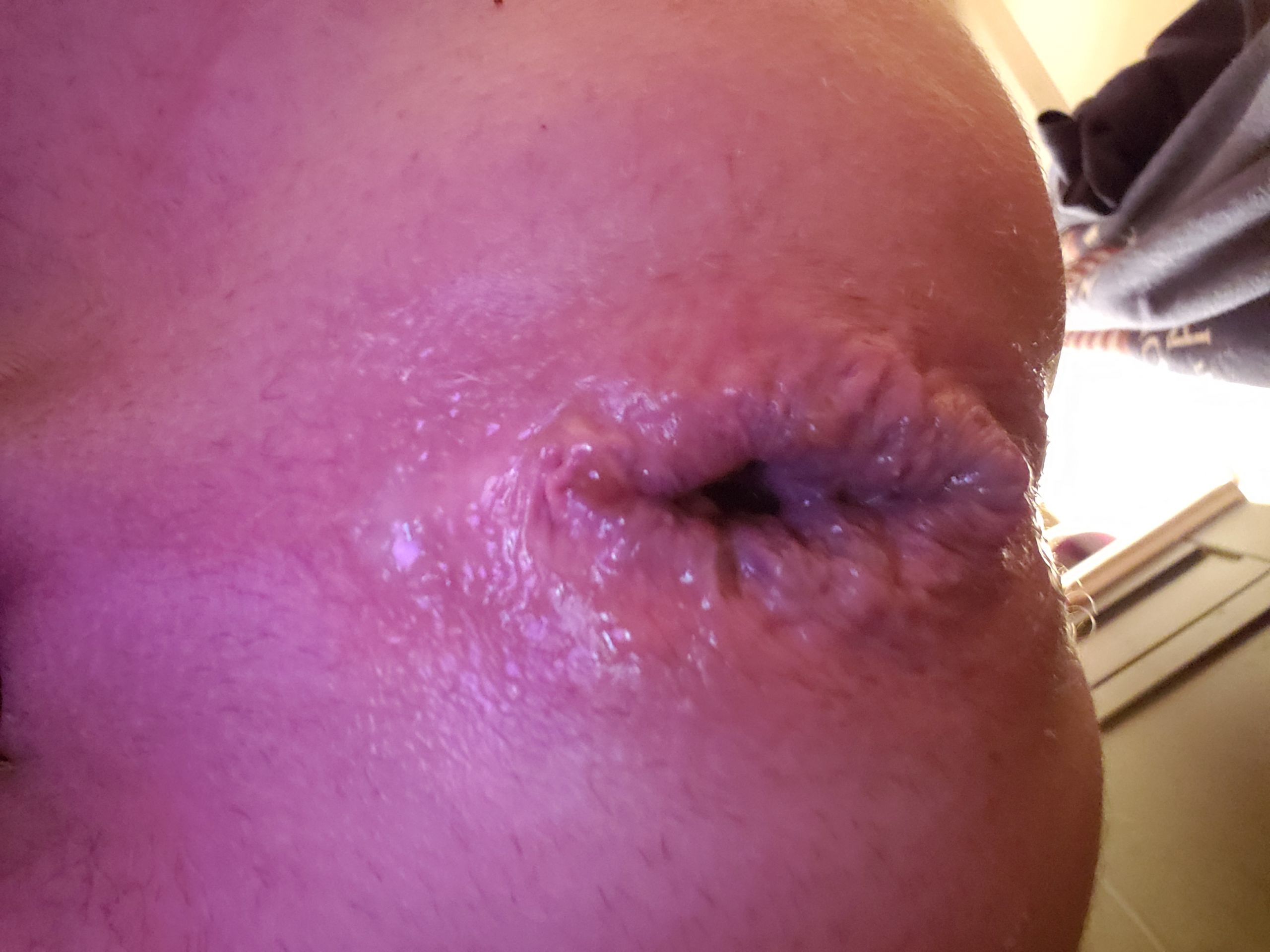 My stretched hole