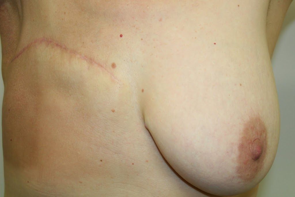 mastectomy and RT tight skin