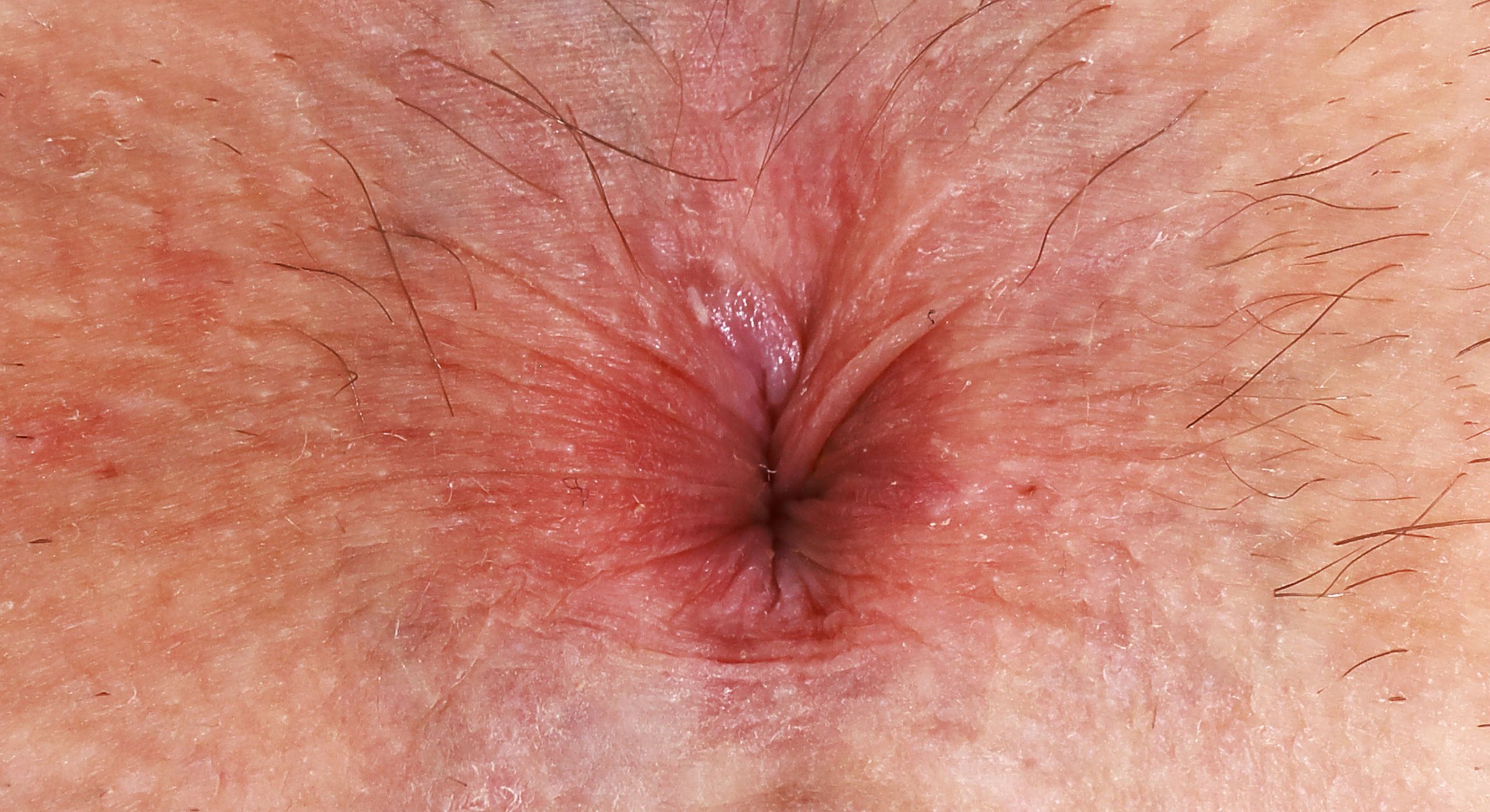 Anus1 (38)