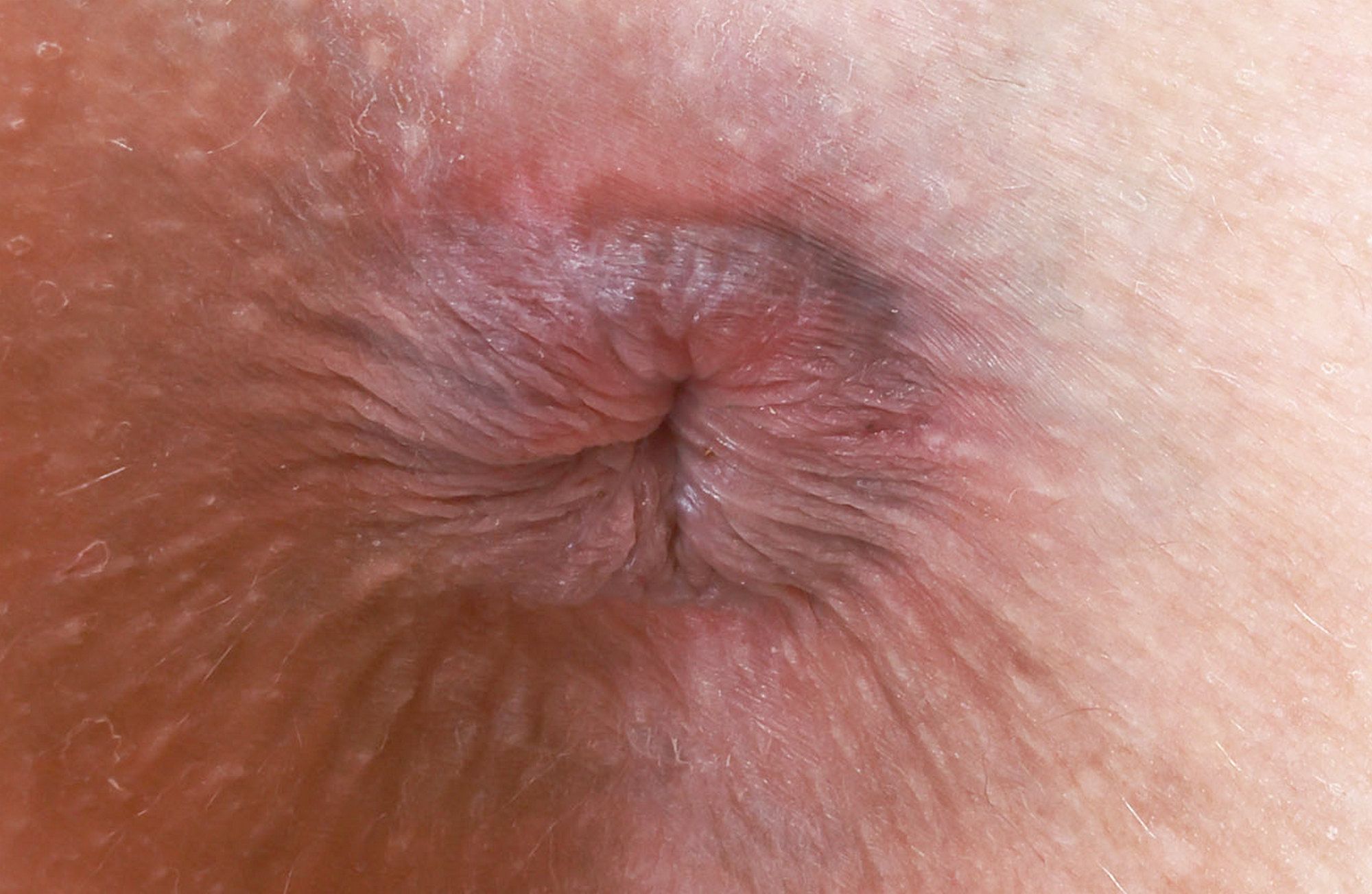 Anus1 (39)