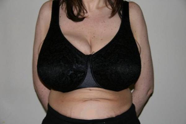 macromastia tits with bra