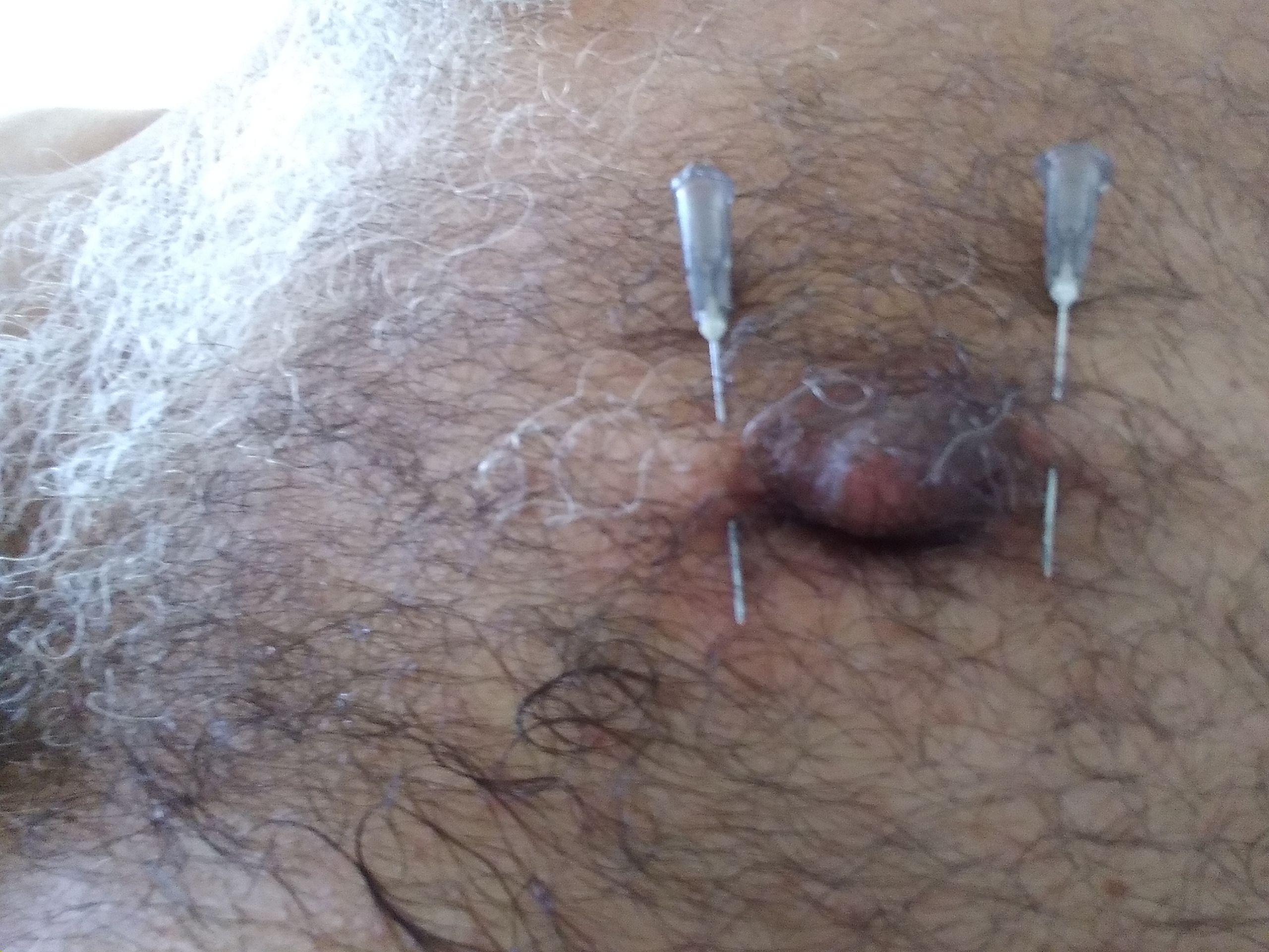 Needles in other nipple too