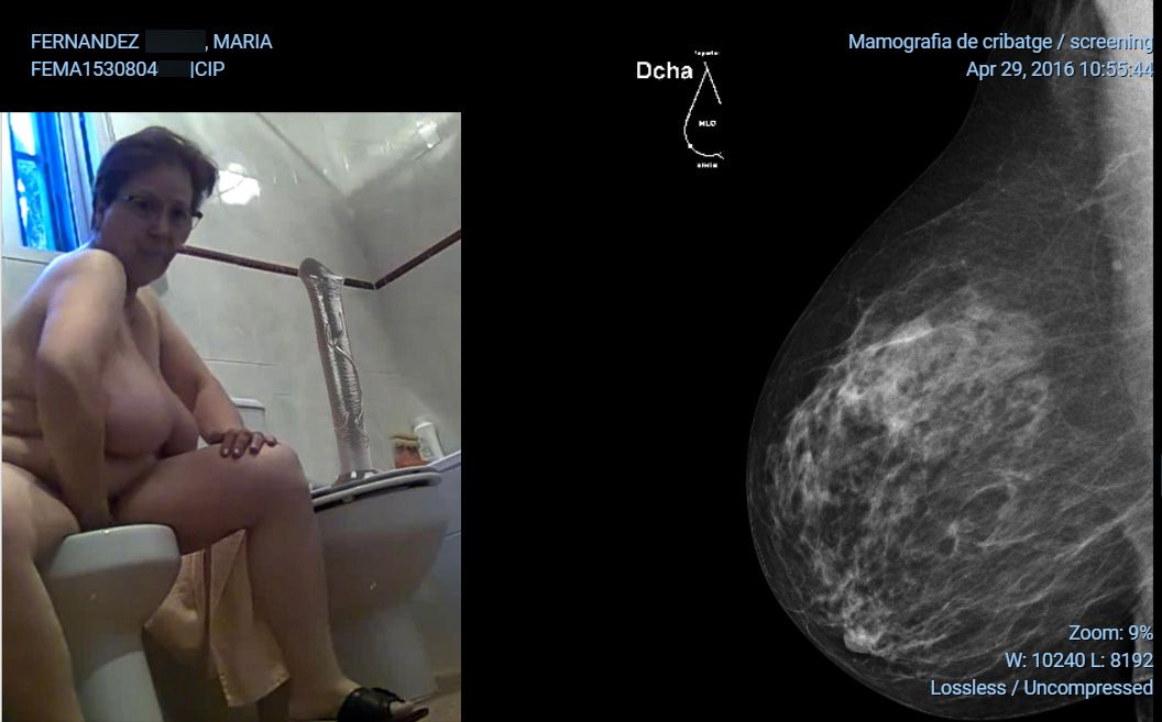Mamografia Maria 2016 pecho derecho