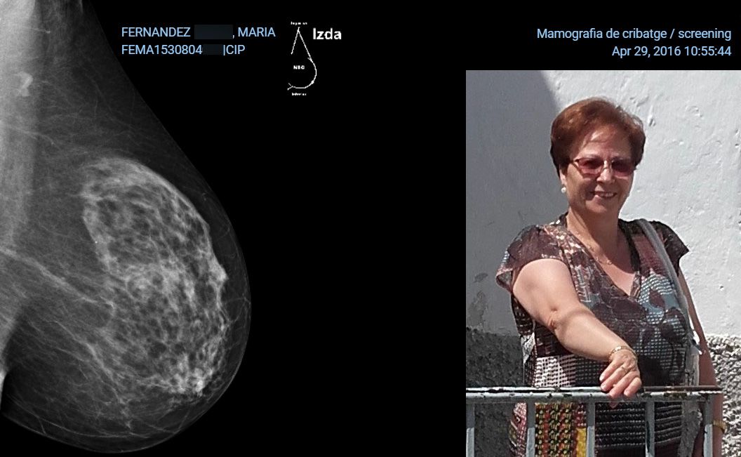 Mamografia Maria 2016 pecho izquierdo