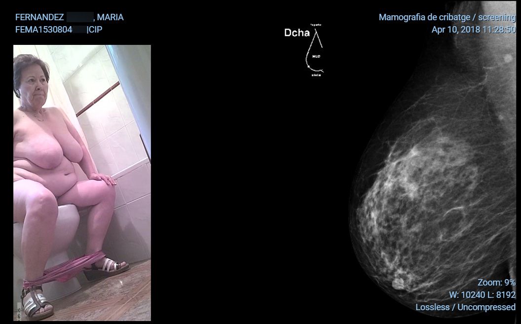 Mamografia Maria 2018 pecho derecho