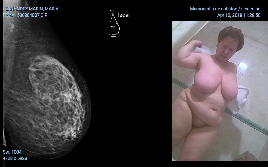 Mamografia Maria 2018 pecho izquierdo