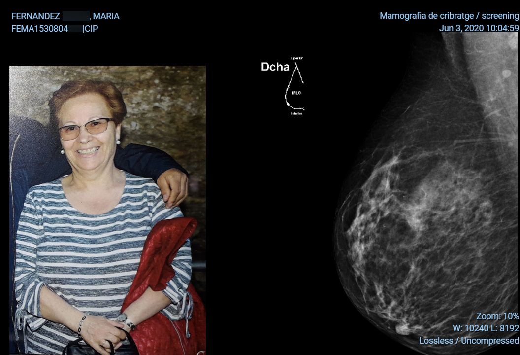 Mamografia Maria 2020 pecho derecho