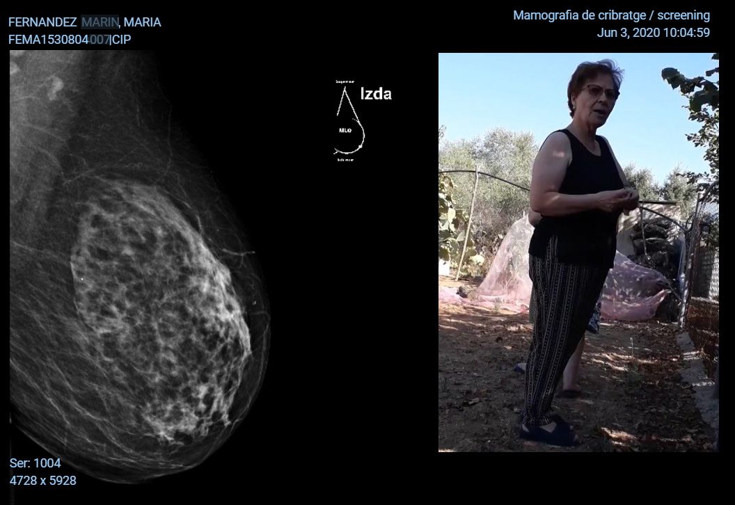 Mamografia Maria 2020 pecho izquierdo