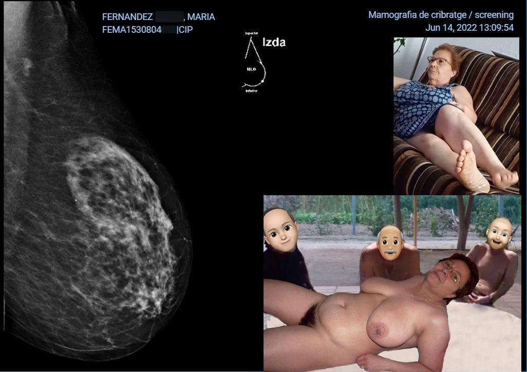 Mamografia Maria 2022 pecho izquierdo