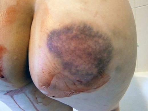 Bruises-&-Menstrual-Blood-d