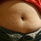 stretch-marks_stomach-230