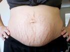 1 week postpartum belly front