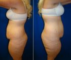 extended-abdominoplasty