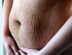 Stretch-marks-due-to-pregnancy1-300x233