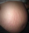 stretch-marks-on-pregnant-stomach