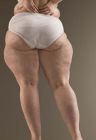 01-cellulite-thighs-1-154640_L