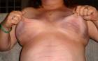bruised tits