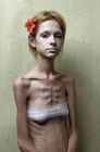 anorexic_2_1