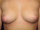 Inverted-nipples-after-surgery