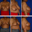 Breast-Reduction-before-132083
