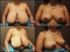 Breast-Reduction-before-160572