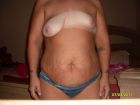 lopsided or uneven breasts (32)