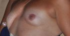 lopsided or uneven breasts (68)