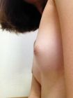 inverted nipples (17)
