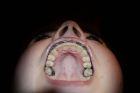 Teeny braceface cummouth