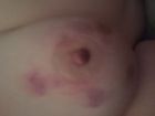 Bitten and bruised tits