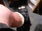 04-18-2019 Tiny Dick Broken Ankle 002