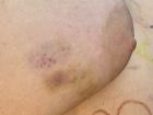 Laurie Bruised TIT