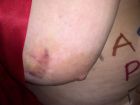 Laurie Bruised TIT