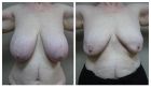 Breast ReductionB&A 2