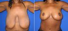 breast-reduction-riverside-before-and-after