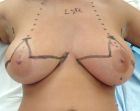 teenage-breast-reduction-design-dr-barry-eppley-indianapolis