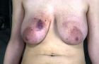 bruised tits