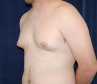 gynecomastia-male-breast-reduction-before-fullsize-42244-83420