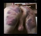 Deep bruises by Mistress, even got some ball bruises and swelling .