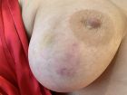 LAURIE WITH BRUISED TIT