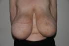 macromastia tits without bra
